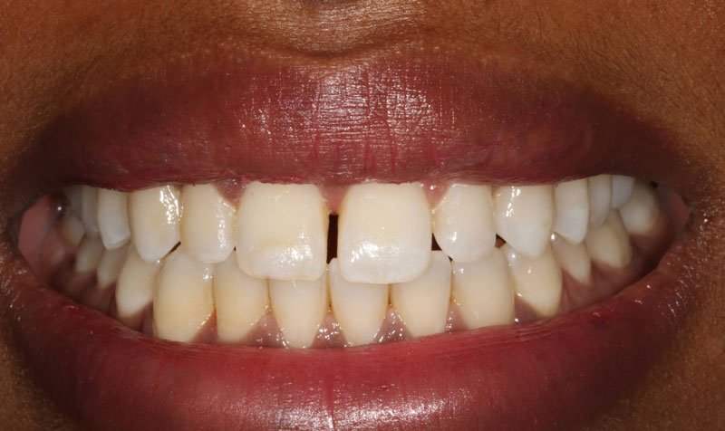 Bonding & Resin Composite Restorations case 162 — before