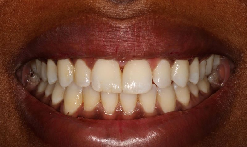 Bonding & Resin Composite Restorations case 162 — after