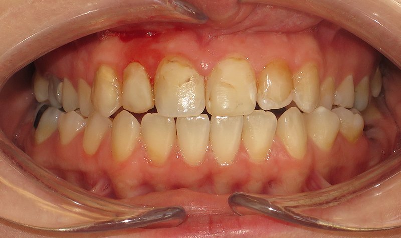 Bonding & Resin Composite Restorations case 163 — before