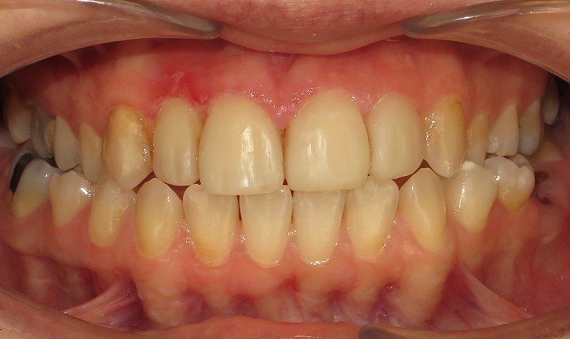 Bonding & Resin Composite Restorations case 163 — after