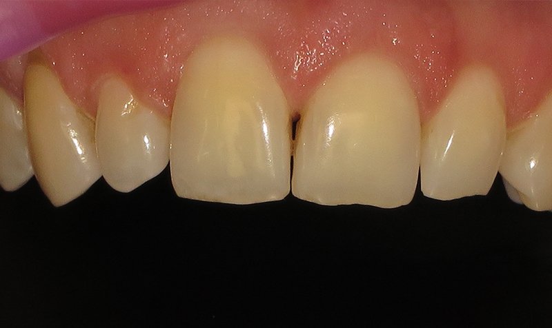 Bonding & Resin Composite Restorations case 164 — before