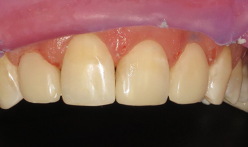 Bonding & Resin Composite Restorations case 164 — after