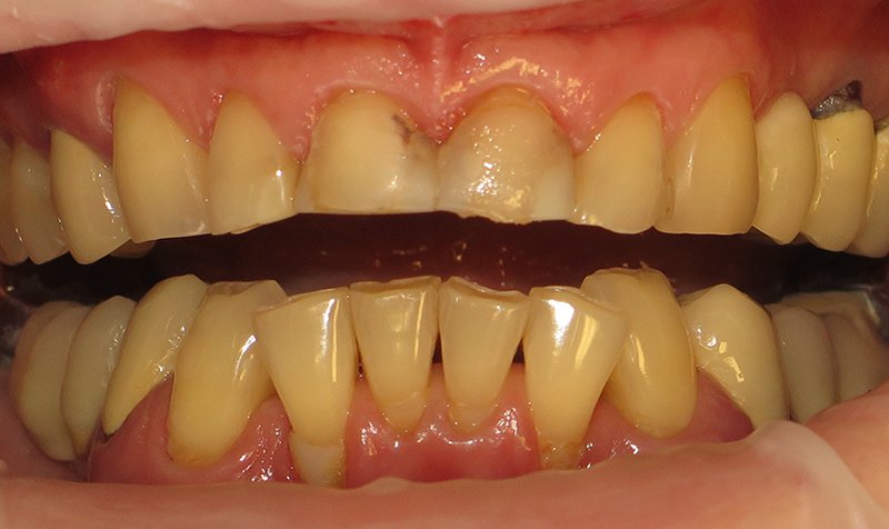 Bonding & Resin Composite Restorations case 172 — before