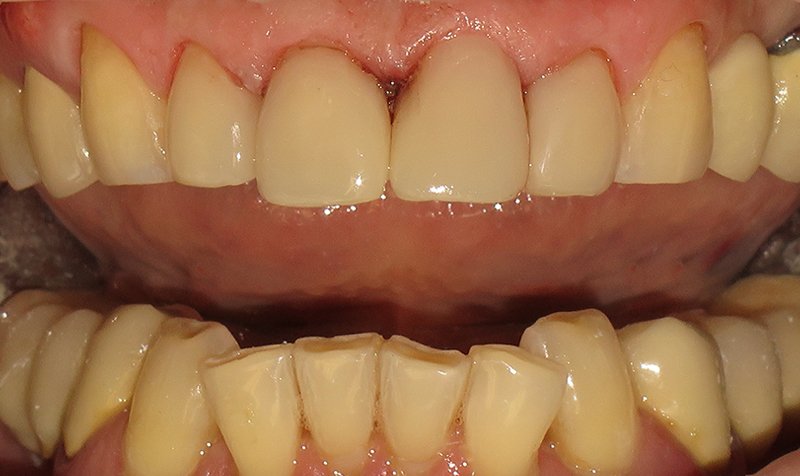 Bonding & Resin Composite Restorations case 172 — after