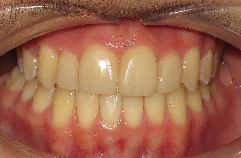 Bonding & Resin Composite Restorations case 180 — after