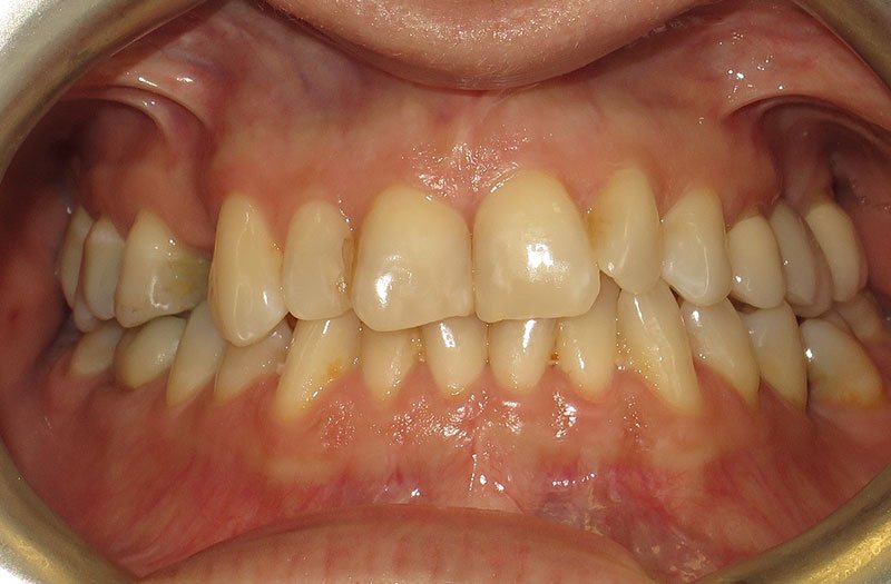 Bonding & Resin Composite Restorations case 182 — before