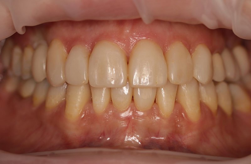 Bonding & Resin Composite Restorations case 182 — after