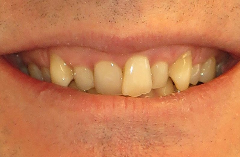 Bonding & Resin Composite Restorations case 184 — before
