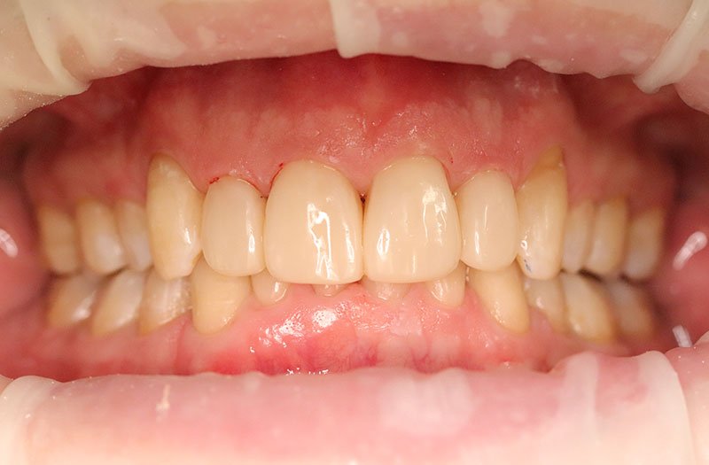 Bonding & Resin Composite Restorations case 184 — after