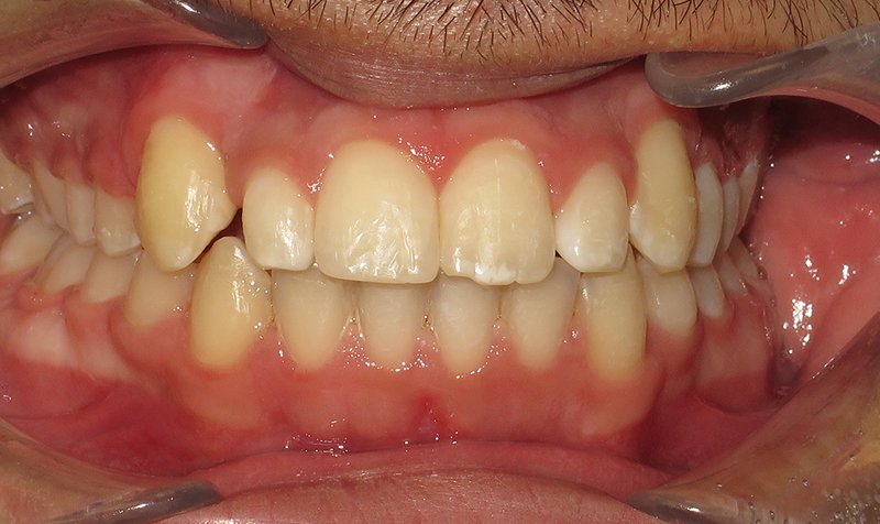 Bonding & Resin Composite Restorations case 194 — before