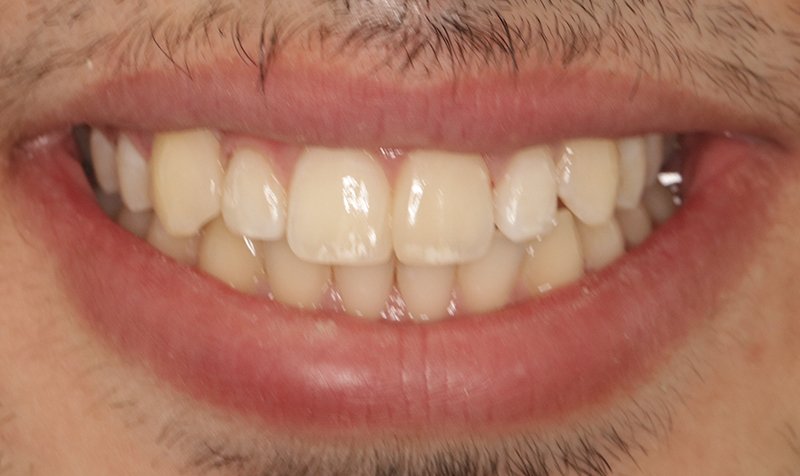Bonding & Resin Composite Restorations case 194 — after