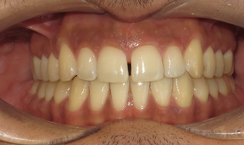 Bonding & Resin Composite Restorations case 195 — before