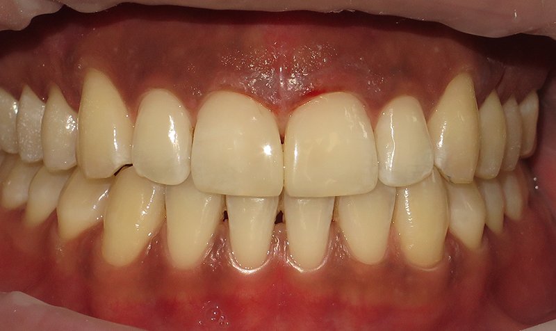 Bonding & Resin Composite Restorations case 195 — after