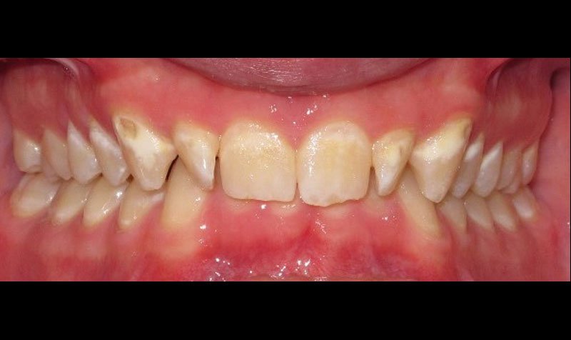Bonding & Resin Composite Restorations case 201 — before