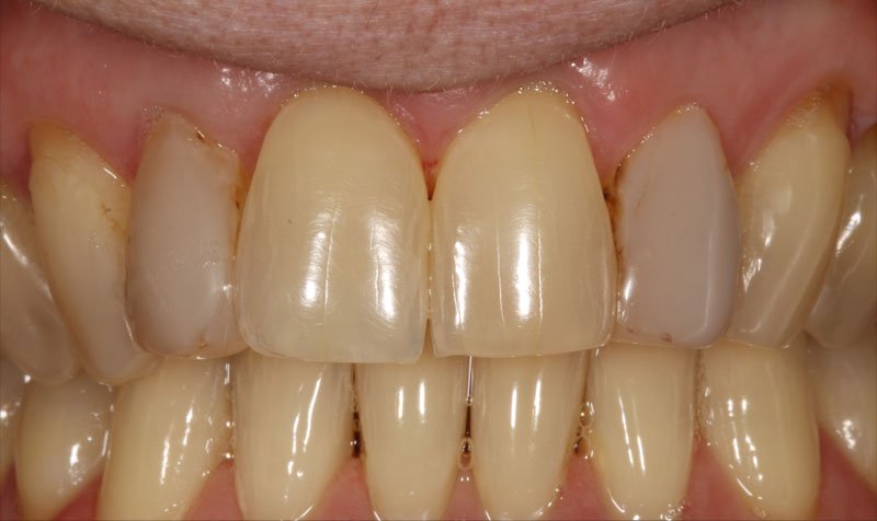 Bonding & Resin Composite Restorations case 202 — before