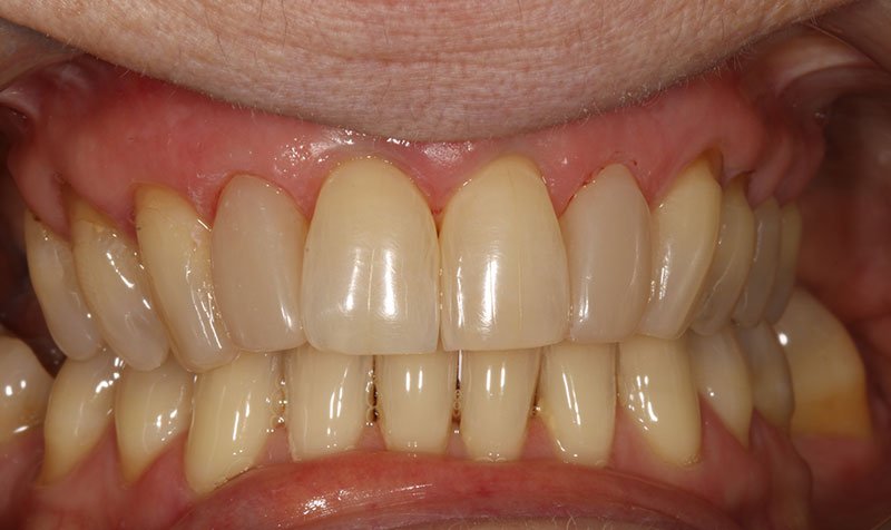 Bonding & Resin Composite Restorations case 202 — after