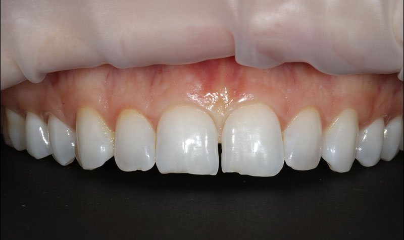 Bonding & Resin Composite Restorations case 203 — before