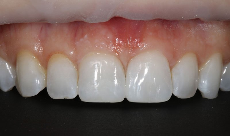 Bonding & Resin Composite Restorations case 203 — after