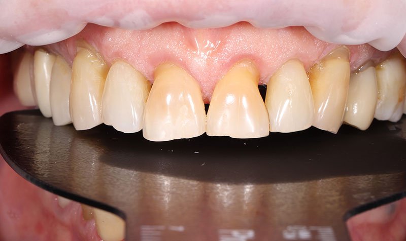 Bonding & Resin Composite Restorations case 204 — before
