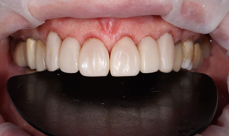 Bonding & Resin Composite Restorations case 204 — after