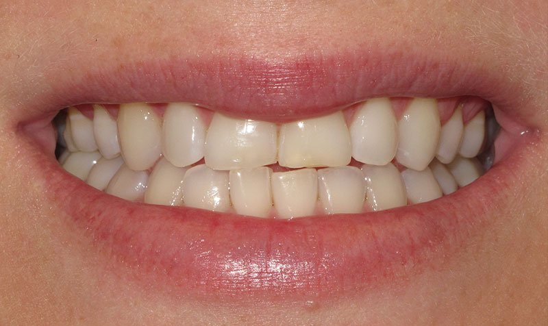 Bonding & Resin Composite Restorations case 205 — before