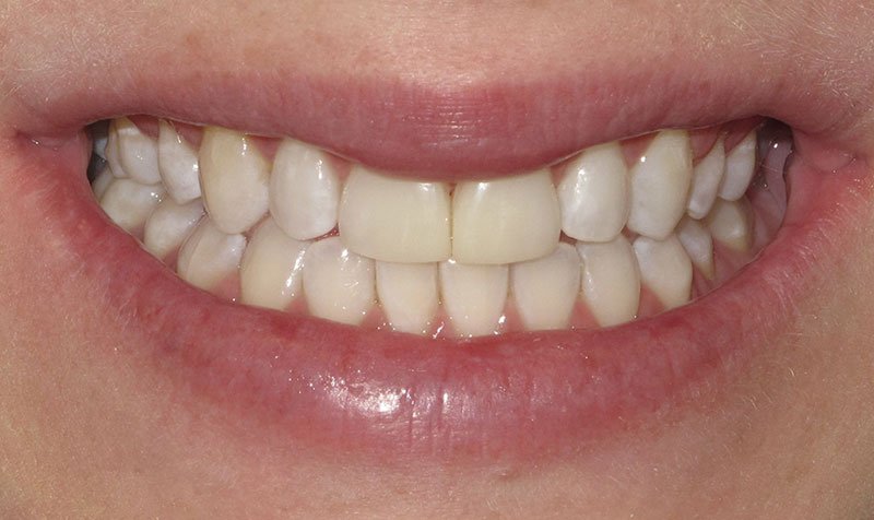 Bonding & Resin Composite Restorations case 205 — after