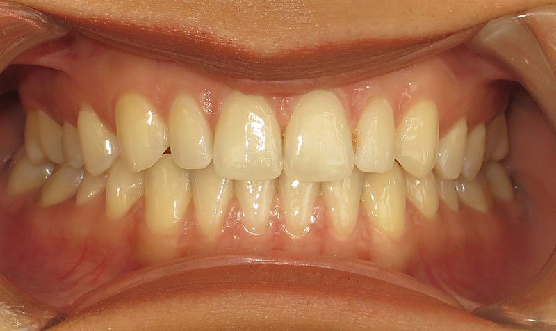 Bonding & Resin Composite Restorations case 207 — before