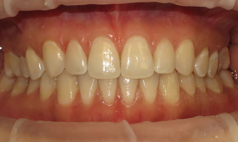Bonding & Resin Composite Restorations case 207 — after