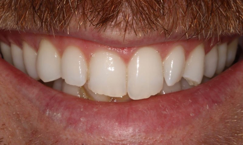 Bonding & Resin Composite Restorations case 215 — before