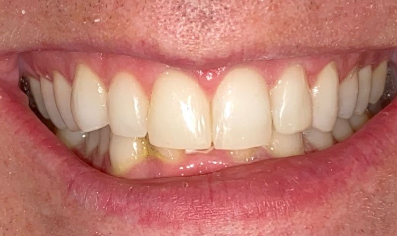Bonding & Resin Composite Restorations case 215 — after
