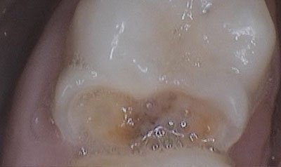 Bonding & Resin Composite Restorations case 31 — before