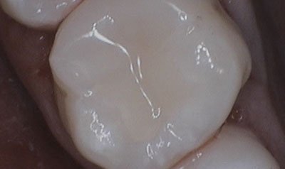Bonding & Resin Composite Restorations case 31 — after