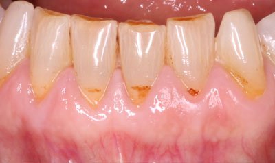 Bonding & Resin Composite Restorations case 37 — before