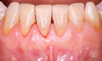 Bonding & Resin Composite Restorations case 37 — after