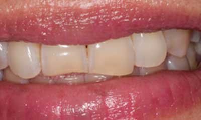 Bonding & Resin Composite Restorations case 42 — before