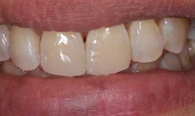 Bonding & Resin Composite Restorations case 42 — after