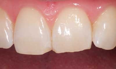 Bonding & Resin Composite Restorations case 46 — before