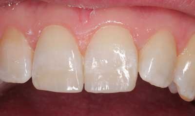 Bonding & Resin Composite Restorations case 46 — after