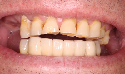Bonding & Resin Composite Restorations case 60 — before