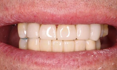 Bonding & Resin Composite Restorations case 60 — after