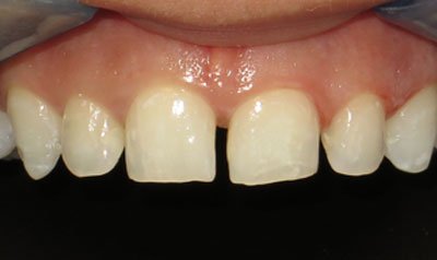 Bonding & Resin Composite Restorations case 75 — before