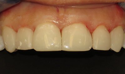 Bonding & Resin Composite Restorations case 75 — after