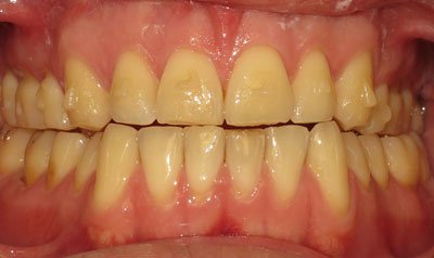Bonding & Resin Composite Restorations case 78 — before