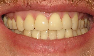 Bonding & Resin Composite Restorations case 78 — after