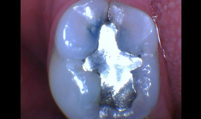 Bonding & Resin Composite Restorations case 82 — before