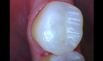 Bonding & Resin Composite Restorations case 82 — after