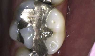 Bonding & Resin Composite Restorations case 84 — before