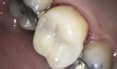 Bonding & Resin Composite Restorations case 84 — after