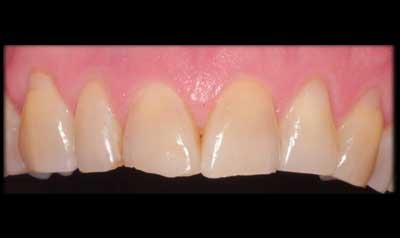 Bonding & Resin Composite Restorations case 93 — before