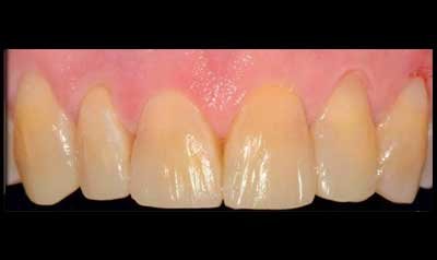 Bonding & Resin Composite Restorations case 93 — after